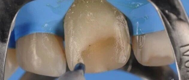 贴面粘接流程：从酸蚀到抛光全步骤（28图详解）