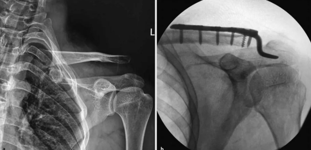 锁骨钩钢板怎么放？偏前 VS 偏后？