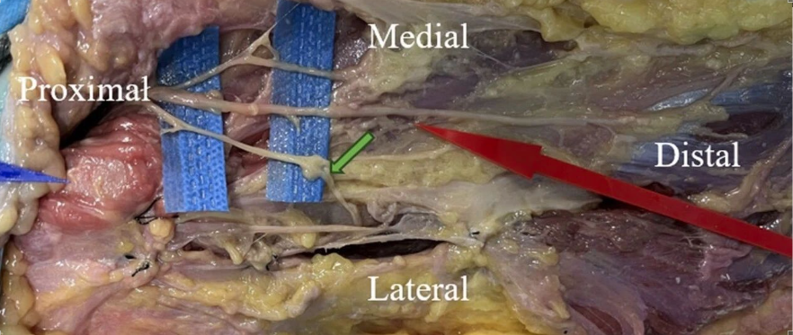 DAA全髋置换：关键解剖标志与操作要点