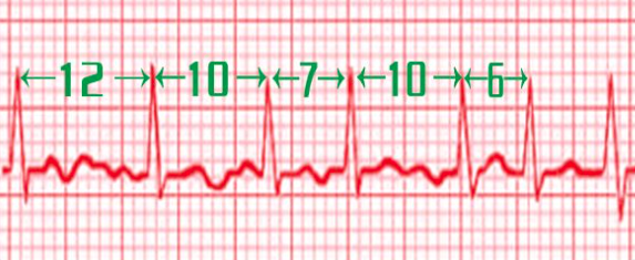 最全心电图详解，值得转发收藏！