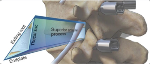 “安全三角”真的安全吗?——脊柱微创里的 Kambin 三角,一次讲透!