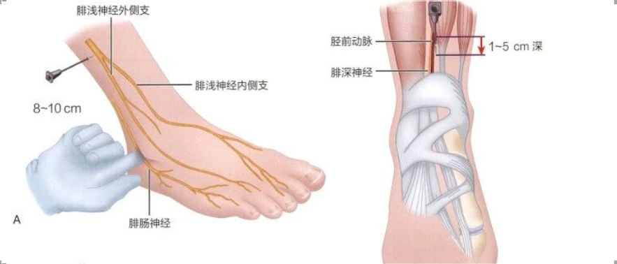 足部手术局麻怎么打，详解踝关节、足部神经阻滞