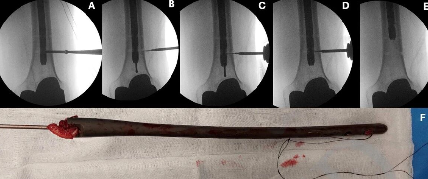 断裂髓内钉取出术--橄榄头导丝加小螺钉的妙用