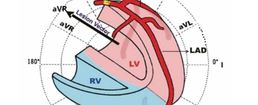 左主干急性完全闭塞的心电图特征