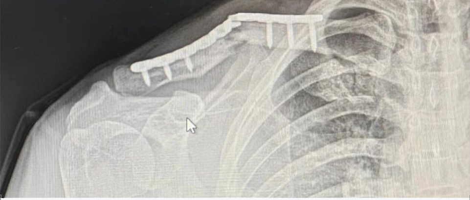 无“为“而治：锁骨断板，必须手术翻修吗？