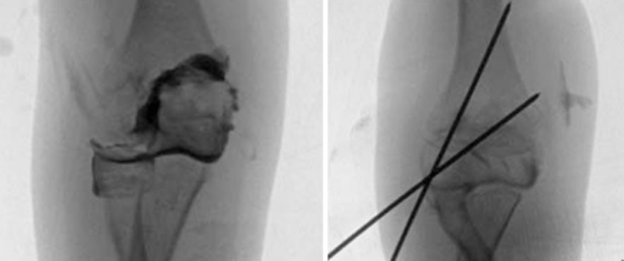 儿童肱骨外髁骨折的诊疗，本文全面总结！