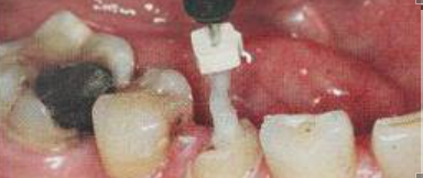 手把手教你纤维桩修复的精细化操作