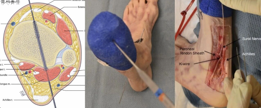 如何安全、有效地经皮置入后踝螺钉？