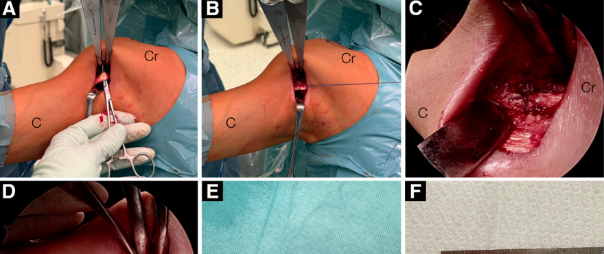 Hosentraeger技术：使用肱二头肌长头腱的关节镜下腱-腱置入术治疗不可修复肩袖撕裂