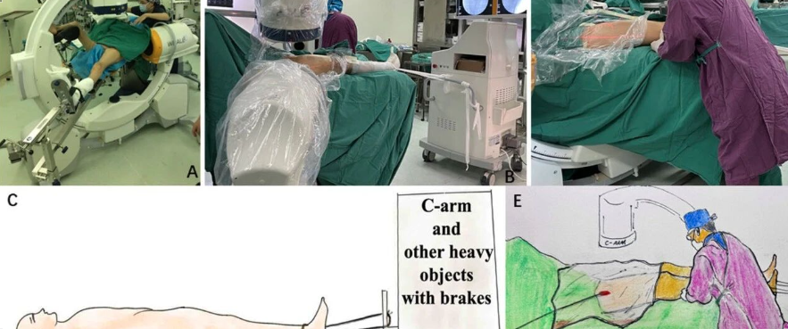 在没有牵引床的情况下，一种简单的牵引方法髓内钉固定粗隆间骨折