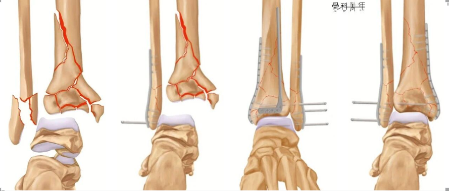 复杂Pilon骨折：“四原则”与“四步定基法”