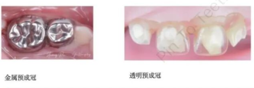 预成冠 · 临床应用与操作规范