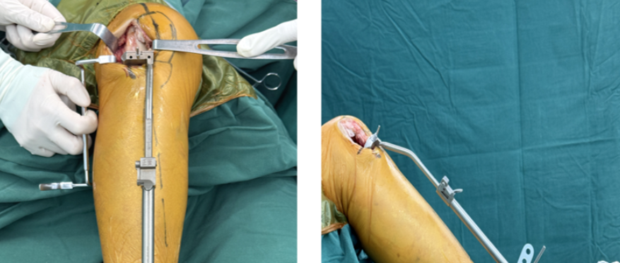 外侧固定平台单髁置换手术技术-(SIGMA® HP KNEE)假体