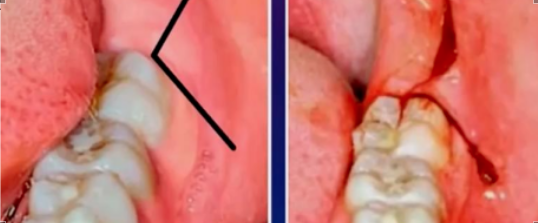 下颌阻生齿拔牙如何翻瓣