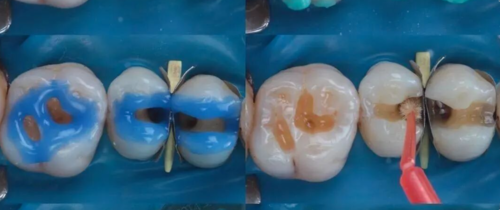 树脂补牙步骤流程