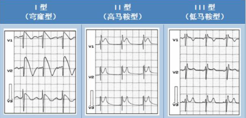 Brugada波与Brugada综合征