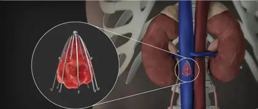 骨折受伤需要手术，下肢出现血栓，什么时候需要放滤器？