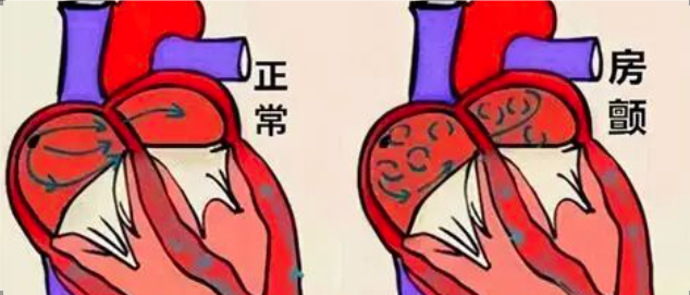 急诊房颤的处理大全