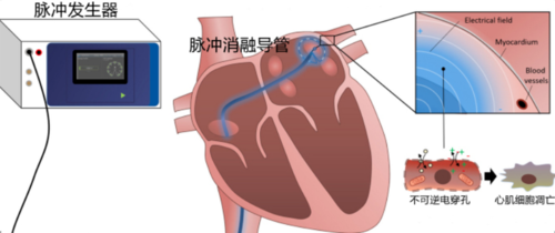 房颤导管消融技术概论