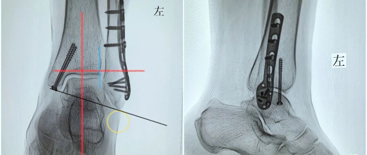 踝关节标准透视的重要性