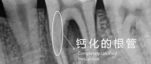 根尖1/3钙化难处理?预弯技巧+EDTA软化,关键在这3步