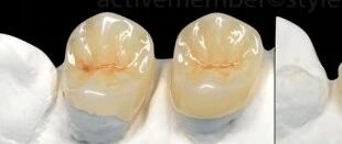 髓腔固位冠，是否可行？