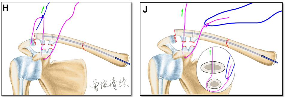 锁骨中段骨折合并同侧肩锁关节脱位新术式：弹性髓内钉+喙锁韧带重建、关节囊缝合