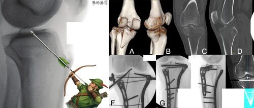 箭与靶:“逆行螺钉技术”固定胫骨髁间棘撕脱骨折