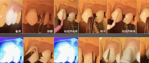 楔状缺损的补牙技巧!全是干货!