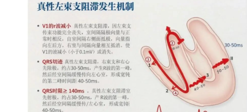 左束支阻滞再认识,实在太全了!