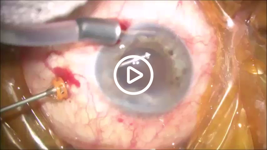 人工晶状体固定技术之改良版yamane