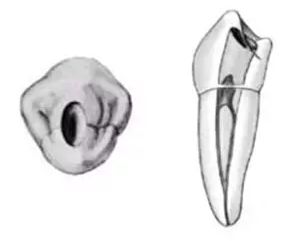 根管治疗图解：6种开髓位置及洞型