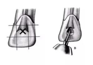 根管治疗图解：6种开髓位置及洞型