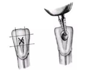 根管治疗图解：6种开髓位置及洞型