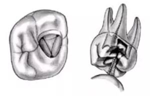 根管治疗图解：6种开髓位置及洞型