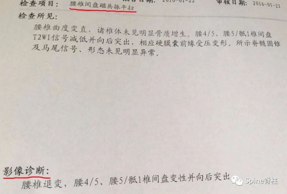 关于腰椎间盘突出症