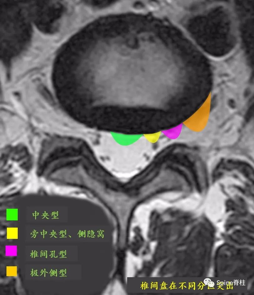 关于腰椎间盘突出症