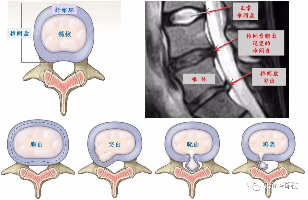 关于腰椎间盘突出症