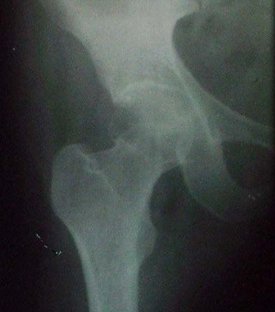 经验丰富骨科医生也棘手的骨折——股骨颈骨折
