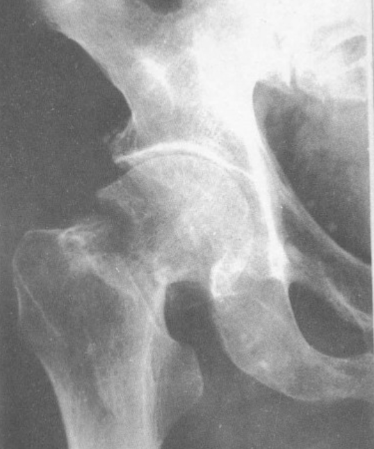 经验丰富骨科医生也棘手的骨折——股骨颈骨折
