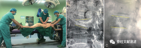 一项治疗Ⅲ期Kummell病的新技术---经椎弓根打压植骨联合后路长节段固定术