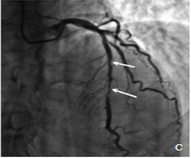 做冠脉CT检查出“心肌桥”，这种“桥”你了解吗？