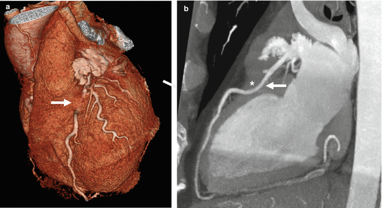做冠脉CT检查出“心肌桥”，这种“桥”你了解吗？
