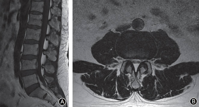 四个诊断腰椎管狭窄的MRI征象