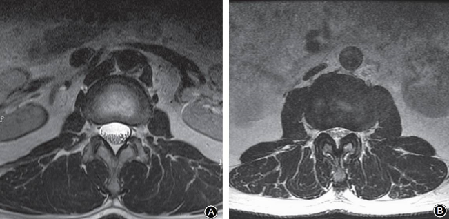 四个诊断腰椎管狭窄的MRI征象