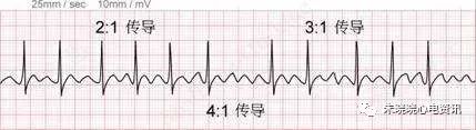 心房颤动与扑动心电图诊断要点