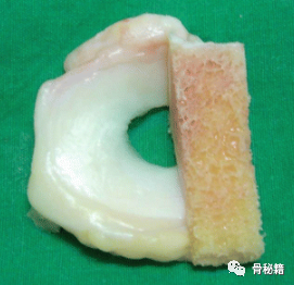 关于半月板损伤，一篇总结到位！