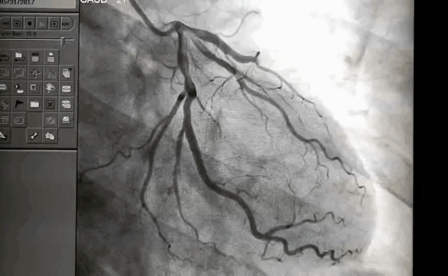 心电图、心脏彩超、心脏冠脉造影的区别，这么解释一看就懂！