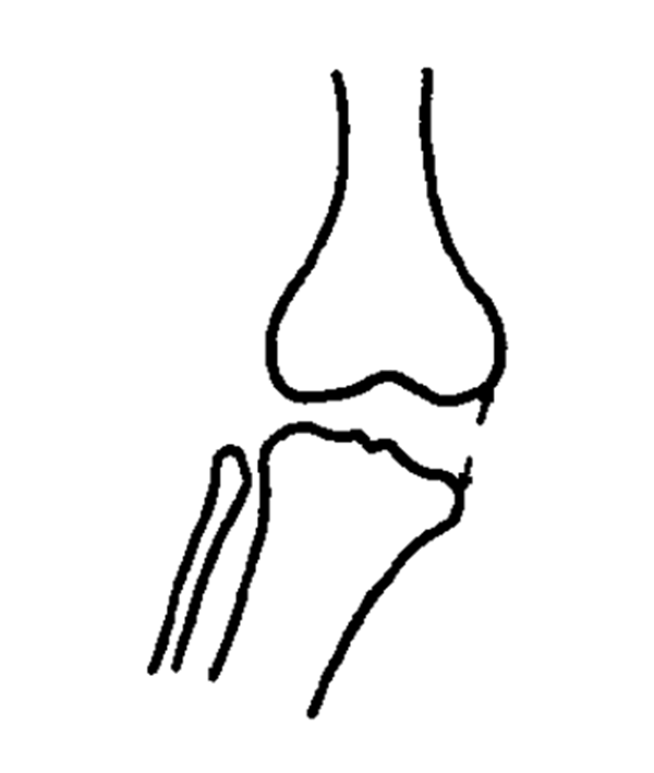 超详细的膝关节X线的基本测量方法，建议收藏