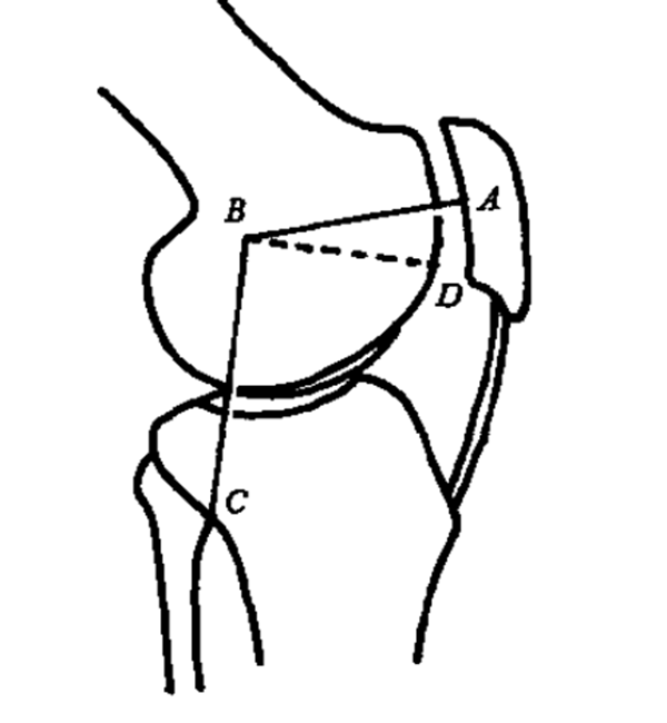 超详细的膝关节X线的基本测量方法，建议收藏